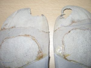 Сколько могут служить подиатрические корректоры?