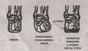 Біль мій від плоскостопості