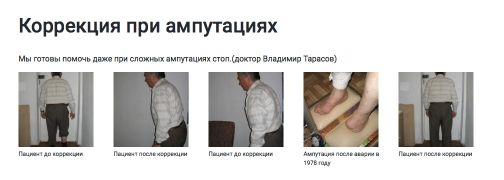 ПОМОЩЬ ПОСЛЕ АМПУТАЦИЙ СТОПЫ!